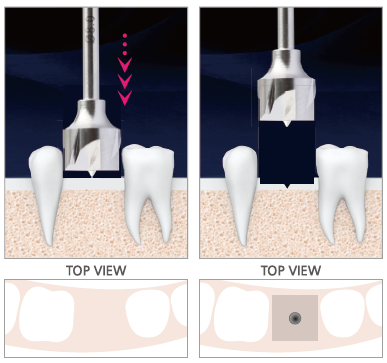 کیت بون تریمر (Bone trimmer) 