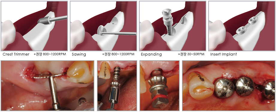 کیت Bone Expander